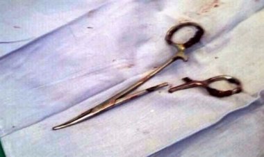 قصة استخراج «مقص» من بطن سيدة بعد 20 عاما على خضوعها لعملية جراحية