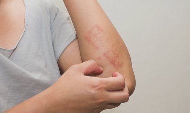 بعيدًا عن الأمراض الجلدية.. أسباب أخرى تدفعك لـ«الهرش»