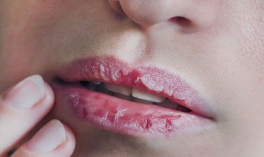 وصفات طبيعية لعلاج «تشقق الشفاه»