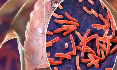 في اليوم العالمي للدرن.. الصحة: انخفاض معدل الإصابة بالمرض بمصر