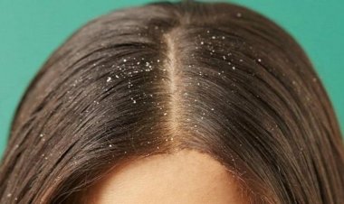 أطعمة تتسبب فى زيادة القشرة.. وخطوات بسيطة للقضاء عليها