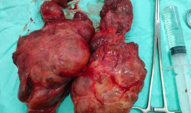 فريق طبي بمستشفى جمال حمادة ينجح فى استئصال غدة درقية ضخمة لسيدة مُسنة في الإسكندرية