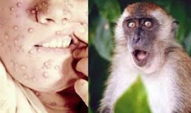 النواب يطالب الصحة بإعلان تفاصيل فيروس «جدري القرود»