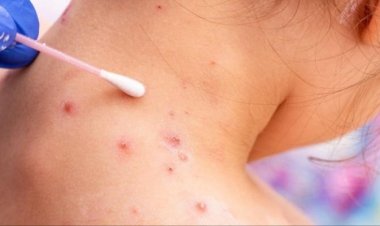 منظمة الصحة العالمية تؤكد إصابة 92 شخصًا بـ«جدري القرود»