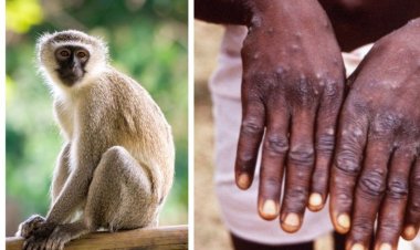 أستاذ مناعة يقدم نصائح للوقاية من جدري القرود: «إلبسوا الكمامة»