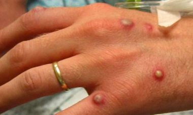 السلطات الصحية الأمريكية تحقق في أول حالة اشتباه بـ«جدري القرود»