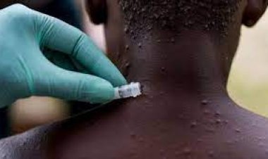 شركة أمريكية تُجري أول اختبار للقاح محتمل للوقاية من جدري القرود