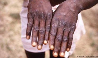 «الصحة الإماراتية» تعلن رصد أول إصابة بجدري القرود لزائرة من «غرب إفريقيا»