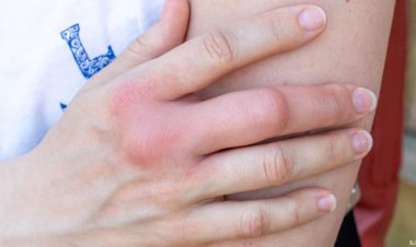 تعرف على أسباب تورم أصابع ايدك أول ما بتصحى من النوم