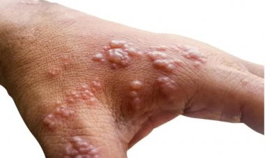 «الصحة الإيطالية» تُعلن رصد 20 حالة إصابة مؤكدة بـ«جدري القرود»