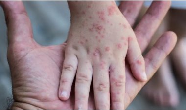 الإمارات تُعلن تسجيل 4 حالات إصابة جديدة بمرض «جدري القردة»