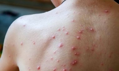 السعودية تعلن رصد أول إصابة بمرض «جدري القرود»