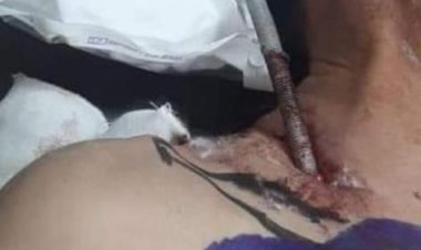 نجاح فريق طبي بجامعة طنطا في استخراج «سيخ حديدي» اخترق جسد عامل