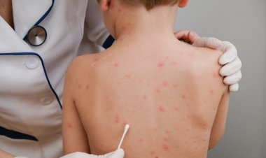 الصحة تكشف تفاصيل الإجراءات الاحترازية بالمطارات لمواجهة جدري القردة