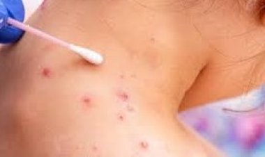 منظمة الصحة العالمية تكشف السبب الرئيسي لـ «جدري القردة»