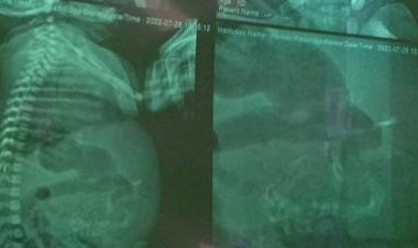 واقعة غريبة.. رضيعة بالدقهلية تحمل جنينًا في بطنها