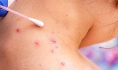 الصحة العالمية ترصد أول حالة لجدري القردة منقولة من البشر للحيوان بباريس