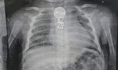 استخراج جسم غريب من جسد طفل عمره 3 أشهر ببنها