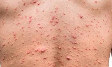 مصر تسجل أول إصابة بجدري القرود قادمة من أوروبا