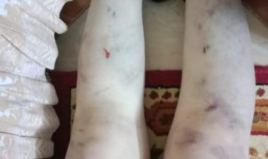 بهدلوا جسمها.. طفلة تتعرض لاعتداء وحشي من والدها وزوجته ببور سعيد