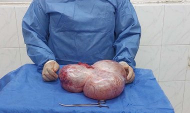 استئصال ورم ضخم من بطن طفلة بطنطا