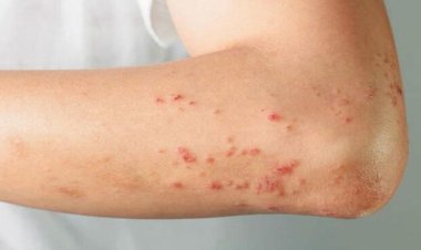 أسباب ظهور «بقع حمراء» على الجلد وطرق علاجها