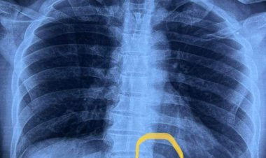 استخراج «إبرة تنجيد» من ظهر مريض بمستشفى بنها الجامعي