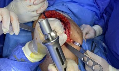 مستشفى أبو حماد المركزي تواصل إنجازاتها في جراحات العظام المتقدمة