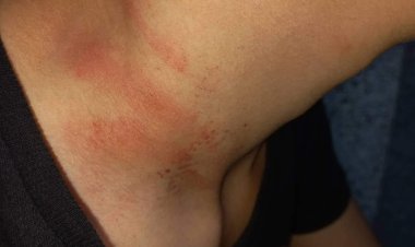 خنقوه وأحدثوا إصابات.. شخصان يتعديان على طالب بعد خروجه من مدرسته ببورفؤاد (خاص)