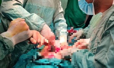 جراحة دقيقة نادرة بالبحيرة.. إنقاذ طفل من انسداد معوي