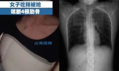 بعد وجبة طعام حارة..  صينية تكسر4 ضلوع أثناء سُعالها