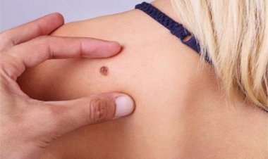 حالة مرضية نادرة لسيدة تحير العلماء.. أصيبت بـ12 ورما سرطانيا وتعافت منهم جميعا