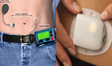 بشرى لمرضى السكري.. العلماء يختبرون البنكرياس الصناعي