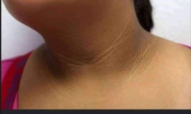 «مش قلة نضافة».. علامة بالرقبة تشير إلى إصابتك بمرض خطير