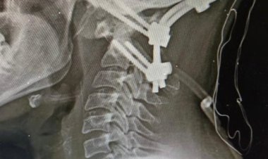 لإنقاذ فتاة من الشلل الرباعي.. مستشفى سوهاج الجامعي تجري تدخلًا جراحيًا نادرًا 