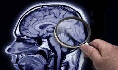 ظهور أصغر حالة بالعالم مصابة بمرض الزهايمر في الصين