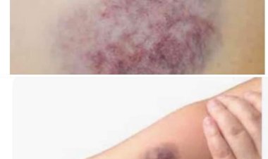 كيف تتخلصين من كدمات الزعل ؟ .. عميد معهد القلب سابقًا يجيب