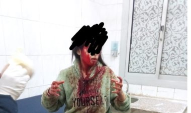 على غرار نيرة أشرف.. شاب يشوه وجه ملكة جمال بـ25 غرزة بالوراق