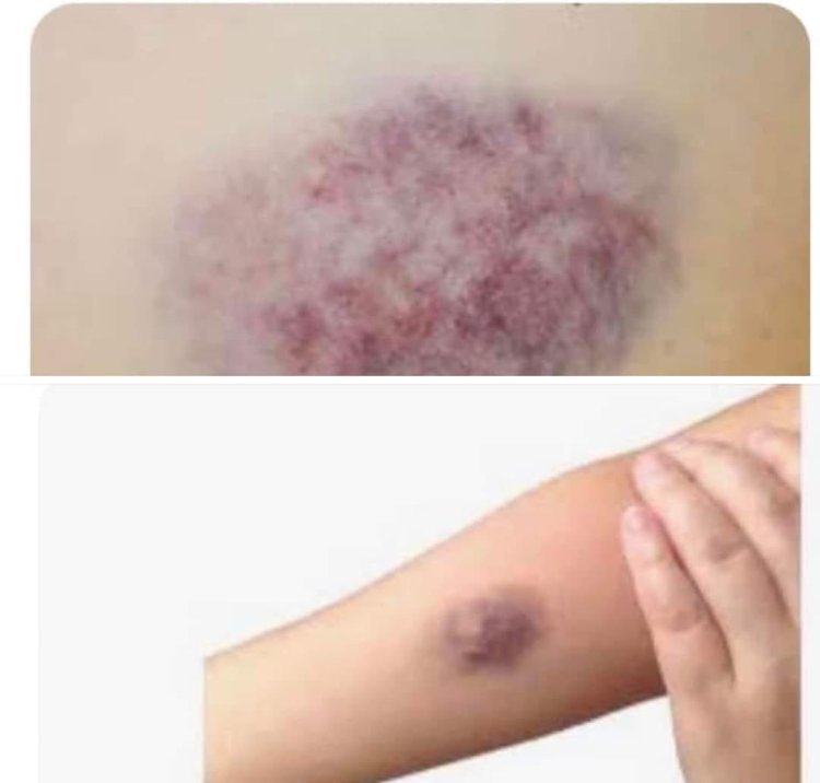 كيف تتخلصين من كدمات الزعل ؟ .. عميد معهد القلب سابقًا يجيب