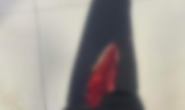 شاب يشوه وجه فتاة  لرفض والدها ارتباطهما..  والشرطة تفحص