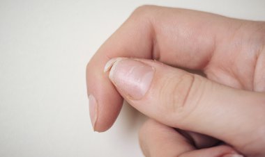 أسباب تقصف الأظافر وطرق علاجها والاعتناء بها