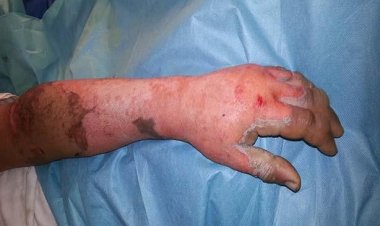 إصابة شخص بحروق في محرقة النفايات بقنا