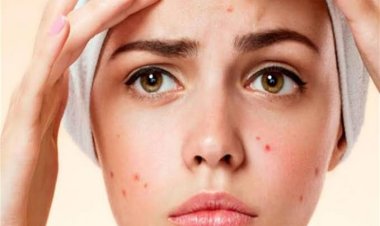 كيف تقضي على «حب الشباب» بوصفة طبية في المنزل ؟