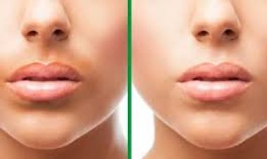 3 طرق للتخلص من تصبغ الفم .. تعرف عليها