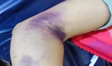 «الحمى النزفية».. حكاية مرض أربك أجساد العراقيين