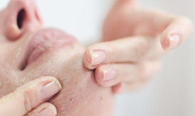 4 وصفات طبيعية لإزالة الجلد الميت