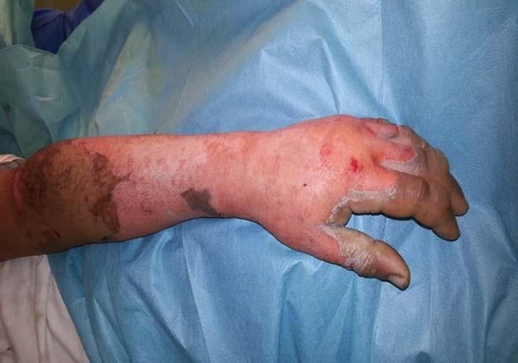 إصابة شخص بحروق في محرقة النفايات بقنا
