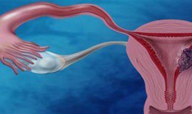 خطورة سرطان عنق الرحم.. طبيب: سريع الانتشار وينتقل عبر التلامس الجسدي