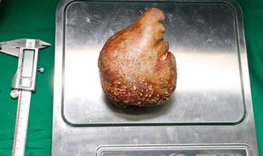 يصل وزنها إلى 800 جرام.. استخراج أكبر حصوة من الكلى يدخل في موسوعة جينيس