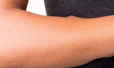 تعرف على 4 طرق طبيعية لإزالة جلد الأوز